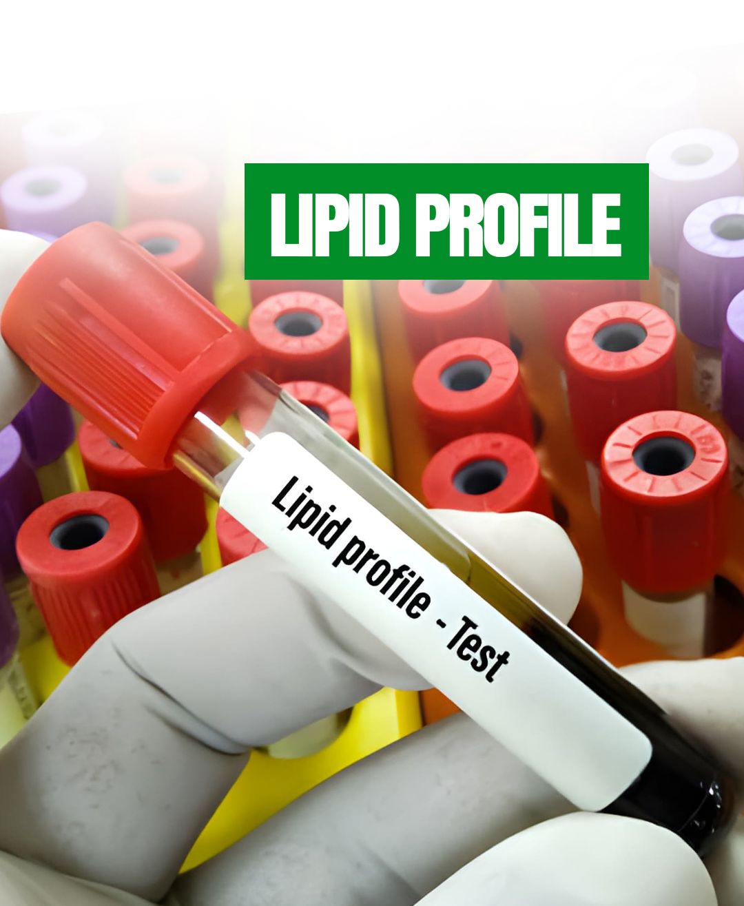 Lipid Profile